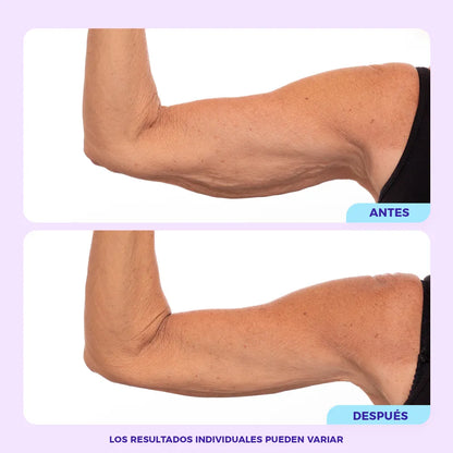 Lifting de Brazos