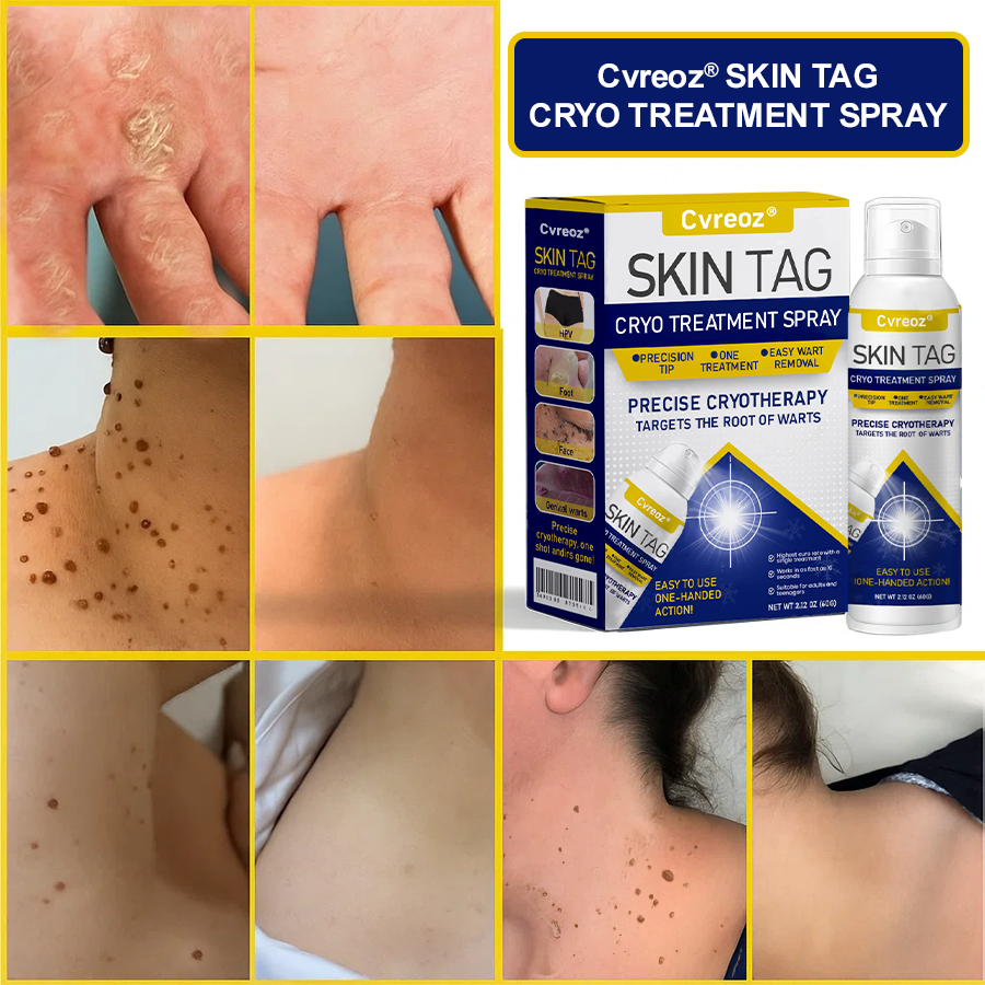 Cvreoz® Skin Tag Cryo Treatment Spray🎁🎁SPECIAL OFFER: 60% OFF This Week Only!