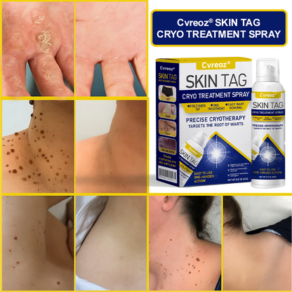 Cvreoz® Skin Tag Cryo Treatment Spray🎁🎁SPECIAL OFFER: 60% OFF This Week Only!
