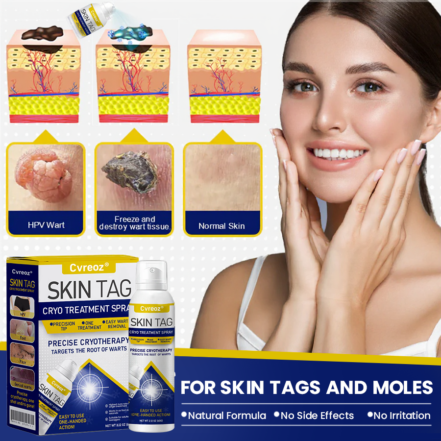 Cvreoz® Skin Tag Cryo Treatment Spray🎁🎁SPECIAL OFFER: 60% OFF This Week Only!