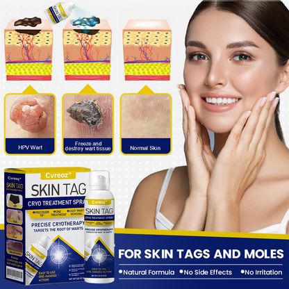 Cvreoz® Skin Tag Cryo Treatment Spray🎁🎁SPECIAL OFFER: 60% OFF This Week Only!