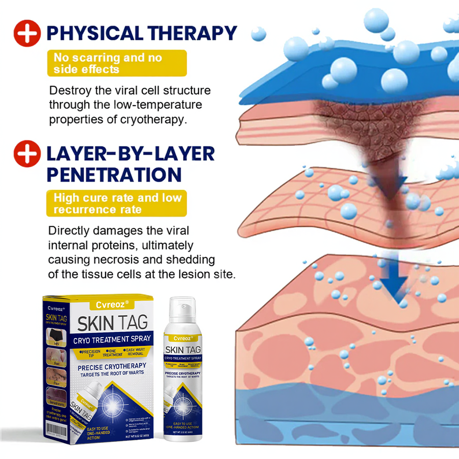 Cvreoz® Skin Tag Cryo Treatment Spray🎁🎁SPECIAL OFFER: 60% OFF This Week Only!